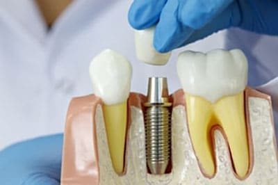 dental implants north bethesda