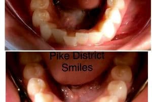 Up and down comparison of dental Invisalign aligners before and after treatment at Pike District Smiles.