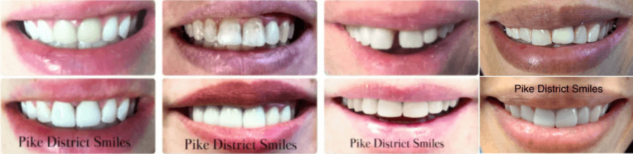 dental_veneers