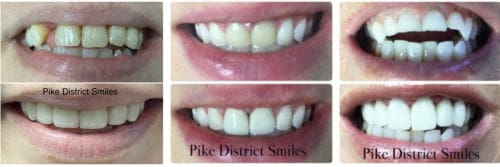 12C16519-8D9F-4C6B-B4F5-447E00A7C925 Dental crowns