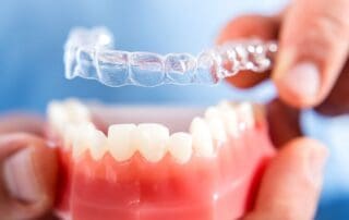 Invisalign aligners being placed on dummy teeth.