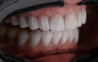 Close-up of patient's teeth with a clean and neat appearance.